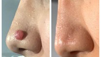 Skin Tag / Cherry Removal